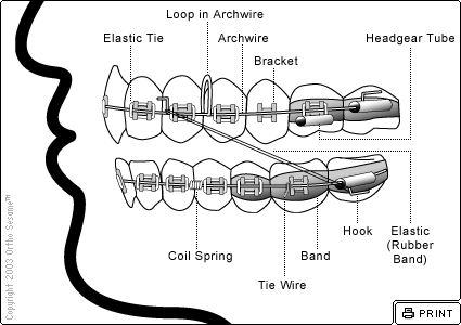 braces diagram