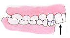 buck teeth