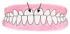 underbite