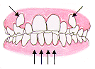spacing between teeth