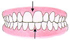 spacing between teeth