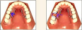 distal jet appliance in orthodontics