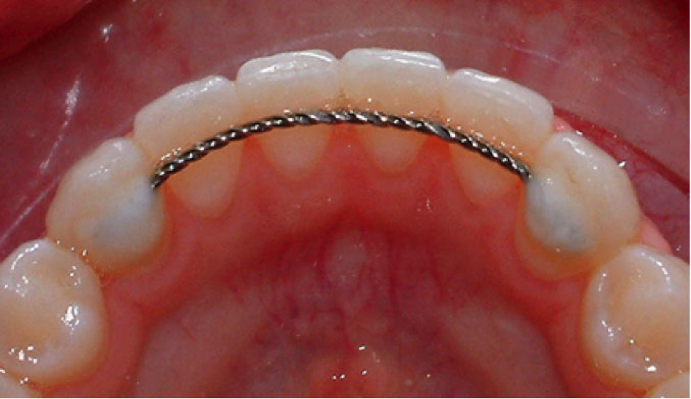 fixed (bonded) retainers in orthodontics