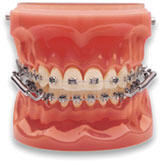 forsus orthodontics