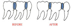 spacers in orthodontics