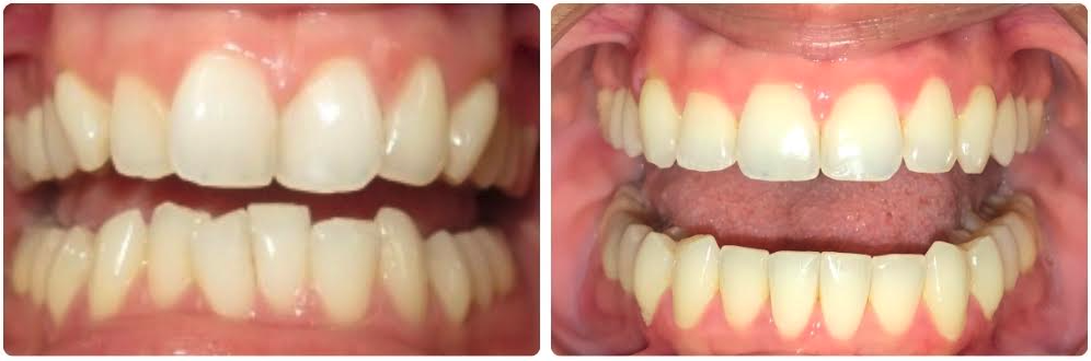Class II division 2 moderate crowding
Invisalign upper and lower aligners
14 months treatment time
