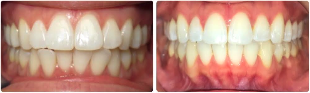 Class I mild crowding
Invisalign upper and lower aligners
8 months
