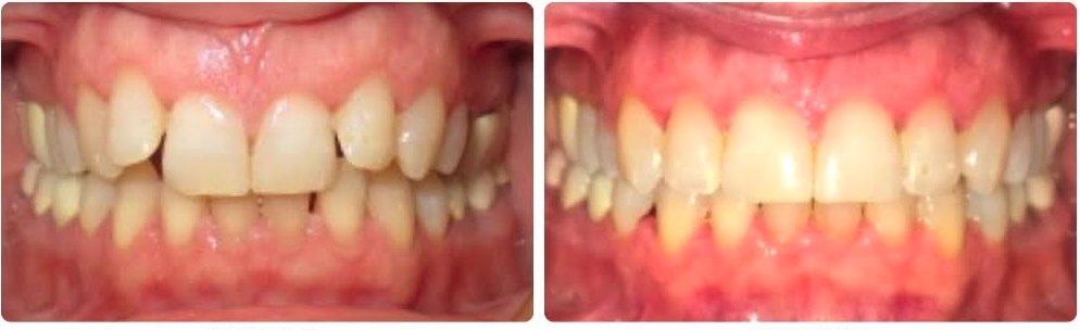 Class II Division 2
Invisalign aligners upper and lower
10 months

