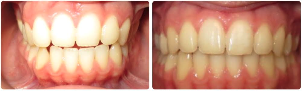 Class III anterior open bite
Invisalign aligners upper and lower
12 months

