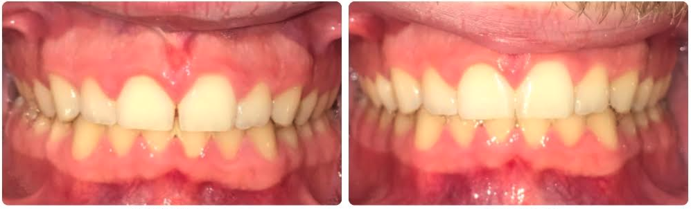 Class I diastema space
Invisalign upper aligners
4 months
