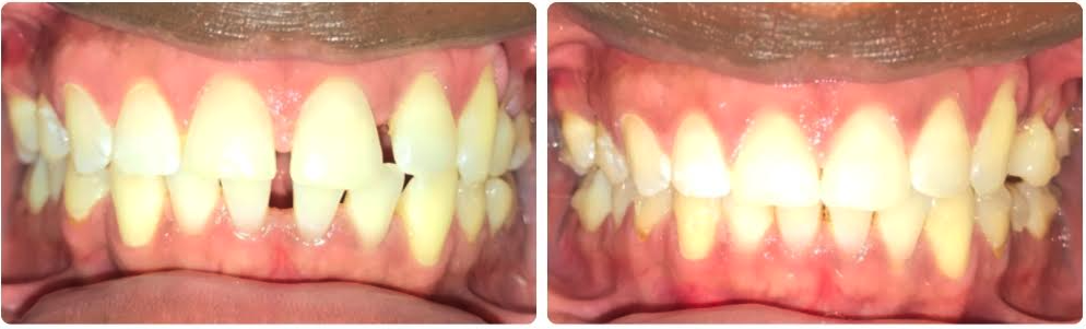 Class I upper and lower spacing
Invisalign upper and lower aligners
11 months
