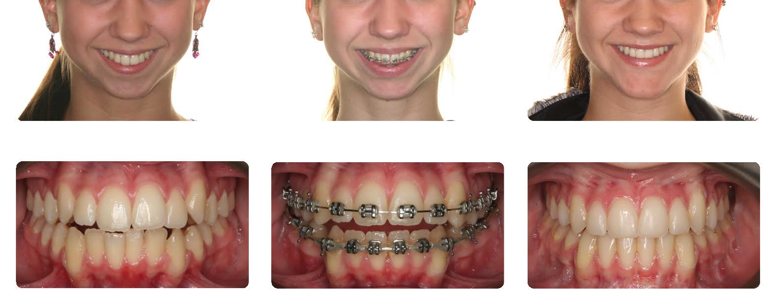 Orthognathic Jaw Surgery Before and After Doctor Emma