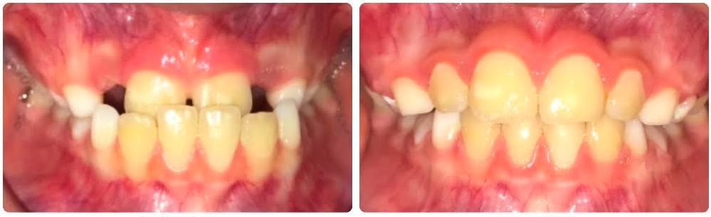 O.D. 8yo
Class III crossbite
Palate expander and Facemask to correct anterior crossbite
10 month treatment
