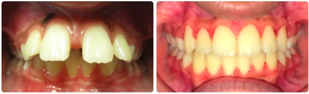 Class II Division I severe overjet
upper and lower braces with upper first premolar extraction
30 months
