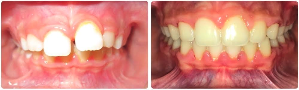 Class II severe crowding and overjet and overbite
Braces upper/lower
30 months