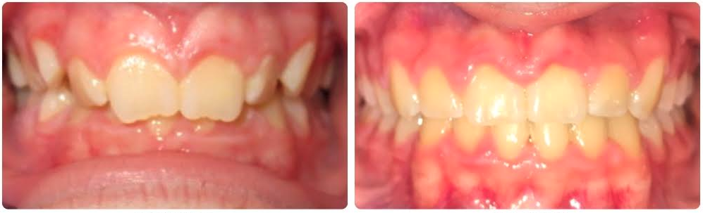 Class II Division 2 deep impinging overbite and crowding
Upper and lower braces 
26 months
