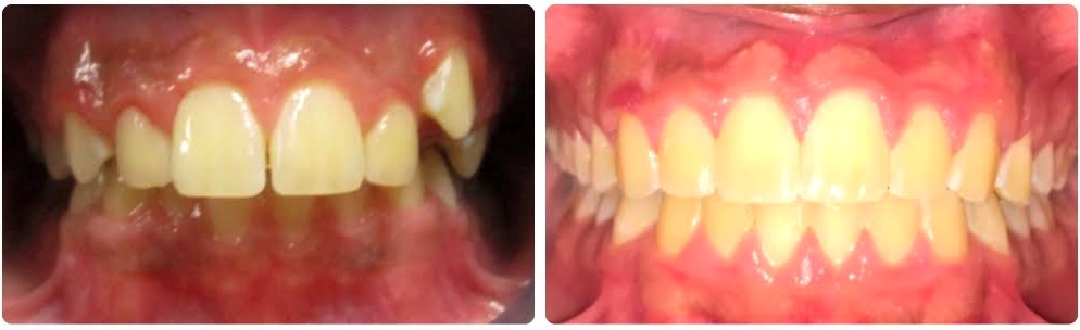 Class II Division 1 sever overjet , moderate overbite, crowding
Upper and lower braces
28 months
