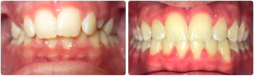 Class I deep overbite and crowding
Braces upper and lower
24 months
