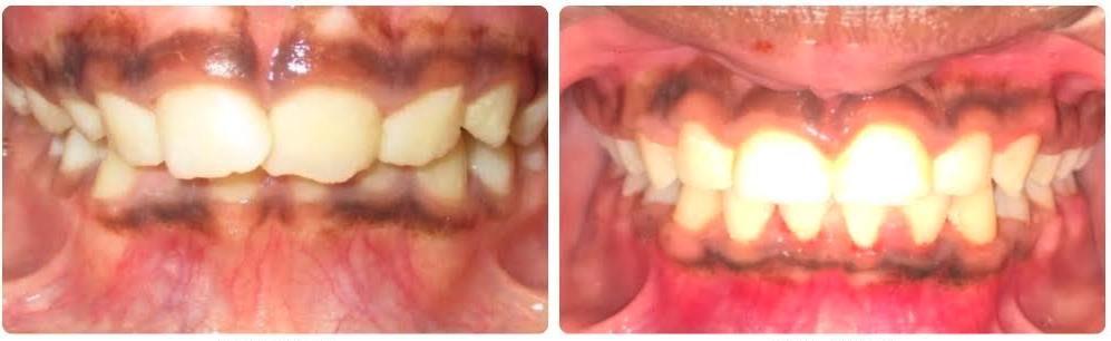 Class I deep overbite moderate crowding
Braces upper and lower
20 months
