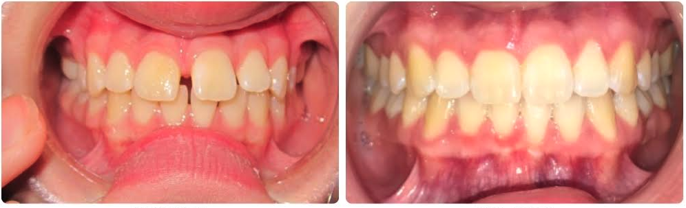 Class I spacing
Invisalign upper and lower clear aligners
8 month

