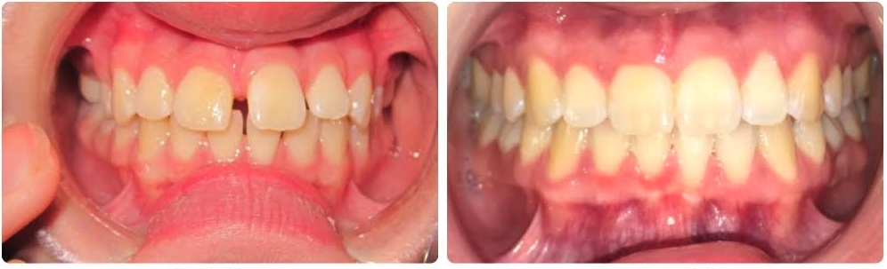 Invisalign Before and After – Doctor Emma