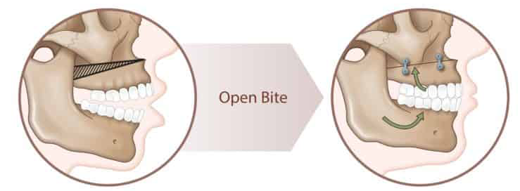 How to use Elastics - Orthodontic Appliances - Doctor Emma